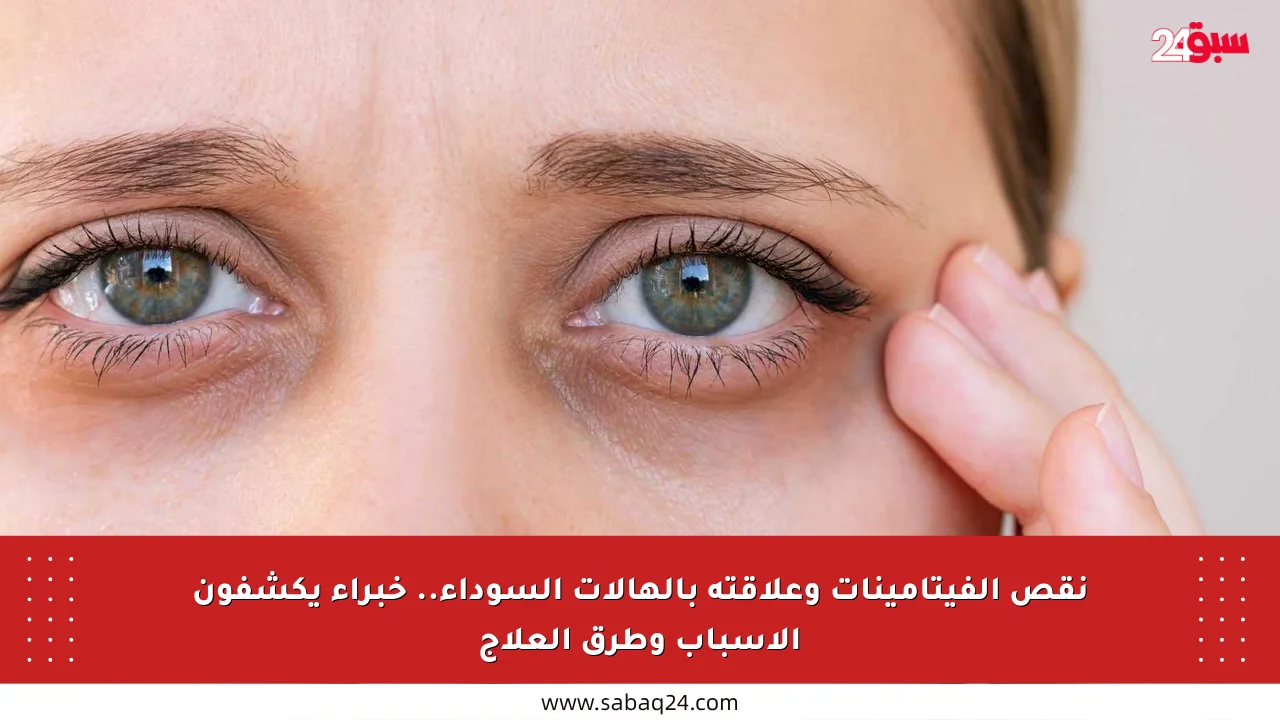 نقص الفيتامينات وعلاقته بالهالات السوداء.. خبراء يكشفون الأسباب وطرق العلاج